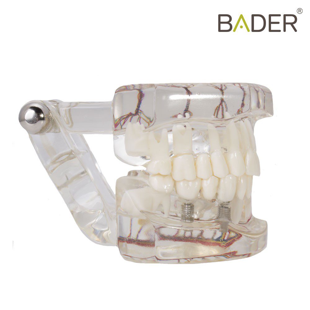 4063-Modèle dentaire d'implant avec nerf.jpg