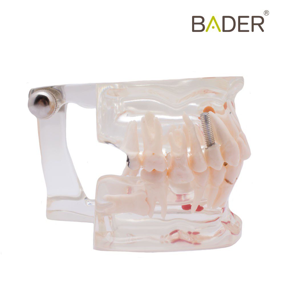 4551-Modèle dentaire transparent avec implant.jpg