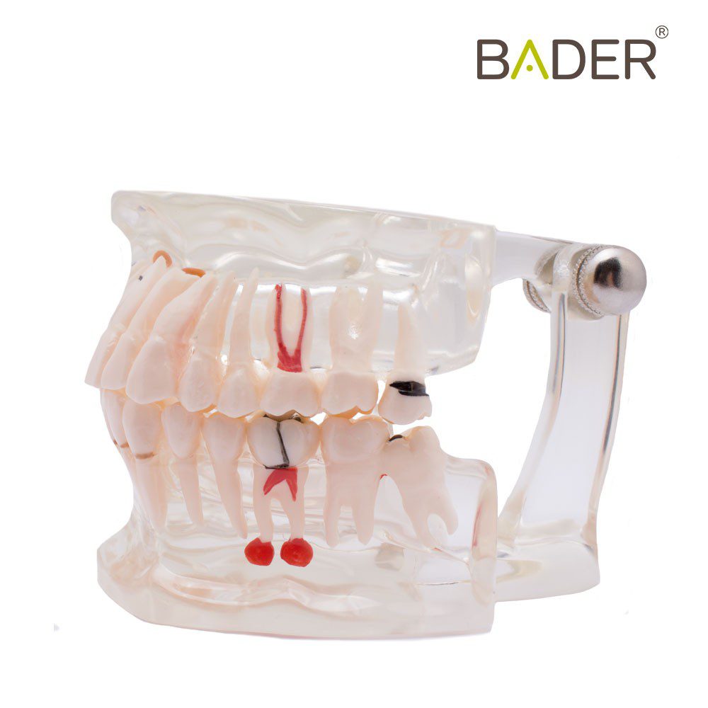 4552-Modèle dentaire transparent avec implant.jpg
