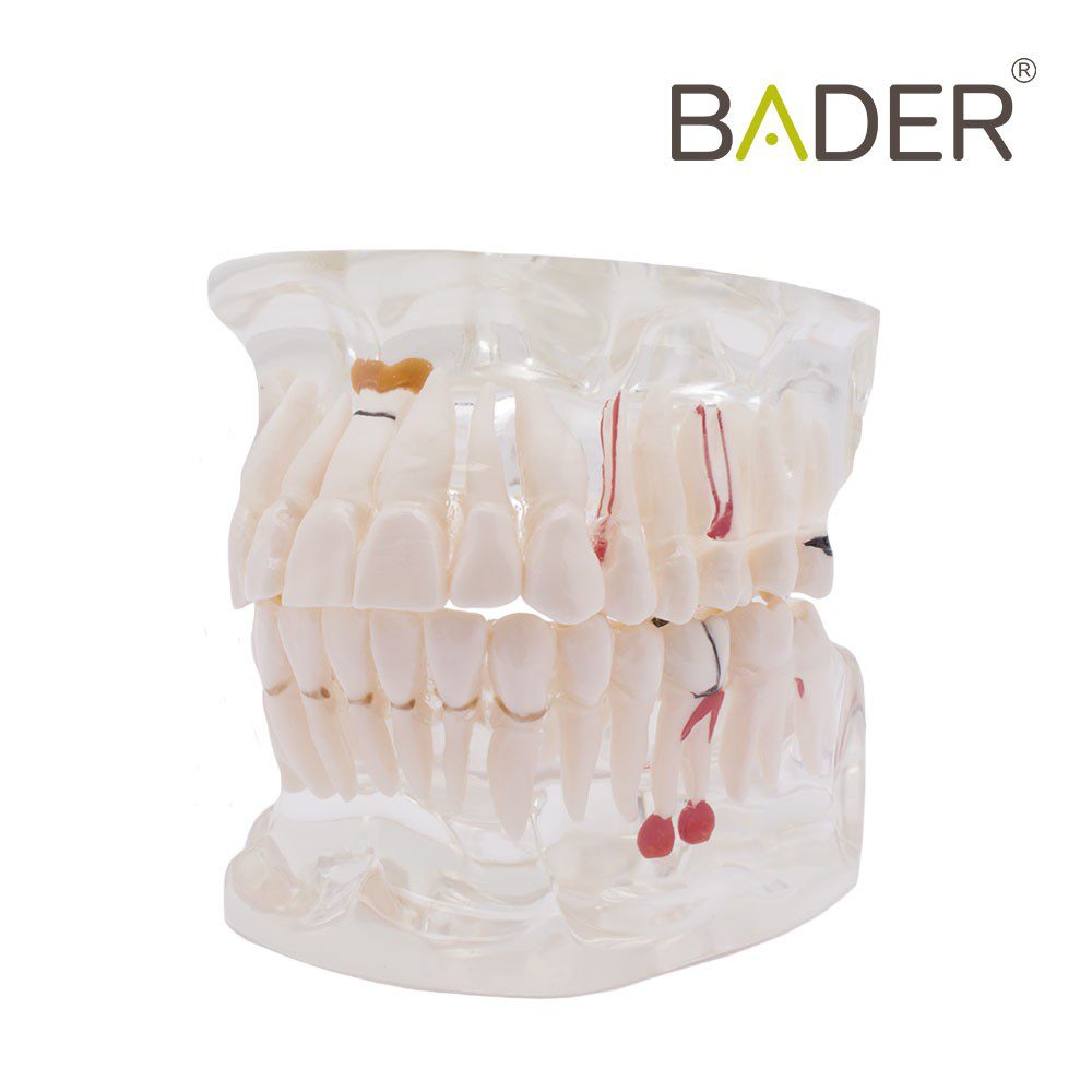 4558-Modèle dentaire transparent avec implant.jpg
